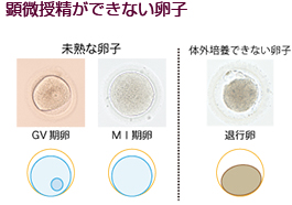 培養室から顕微授精ができない卵子