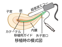 培養室から移植時の模式図