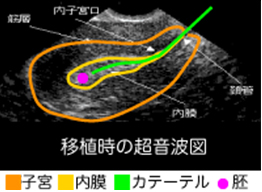 培養室から移植時の超音波図