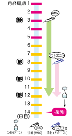 体外受精・アンダゴニスト法スケジュール