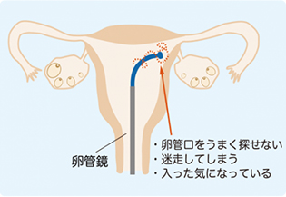 FT(卵管鏡下卵管形成術)卵管鏡のみの場合イメージ