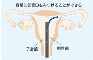 FT(卵管鏡下卵管形成術)子宮鏡を併用イメージ