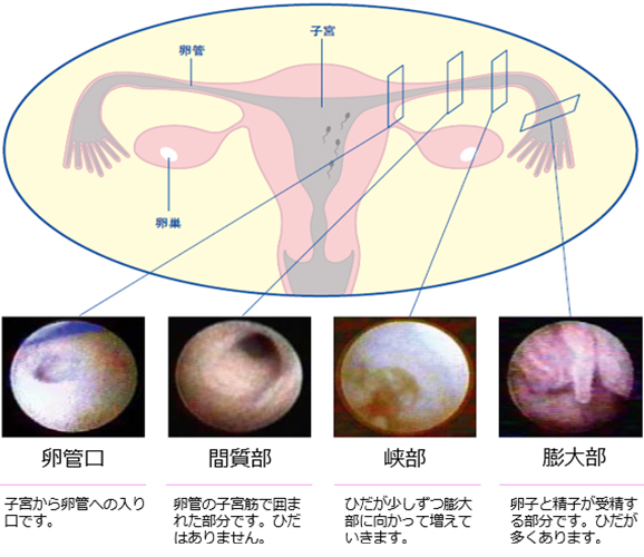 FT(卵管鏡下卵管形成術)写真