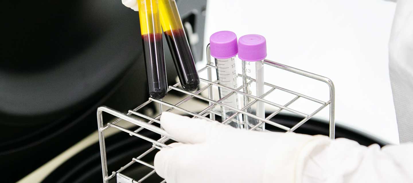 PRP療法(Platelet Rich Plasma・多血小板血漿)写真